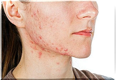 Acne on the skin of the face