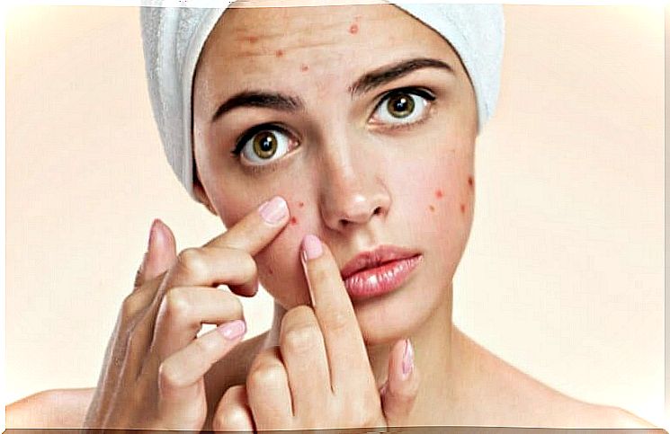 Woman with acne