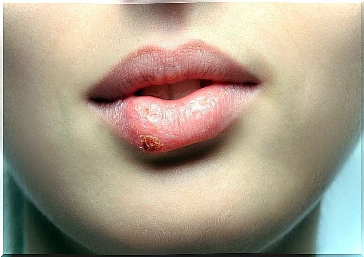 Woman with rash on lips