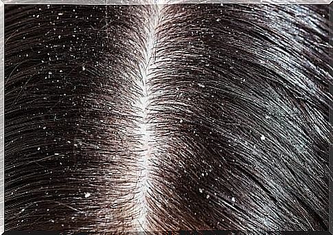 Scales in the scalp