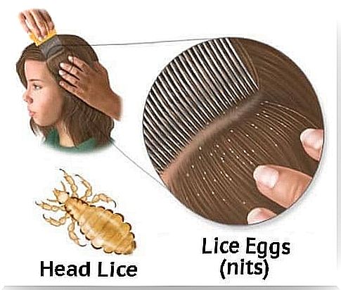 5 homemade solutions to fight lice