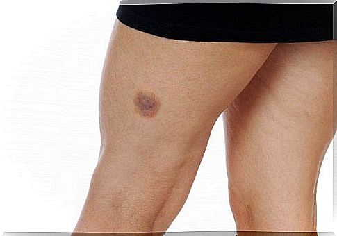 A lady who wants to treat bruises on her leg.