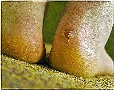 Cures your blisters quickly with natural medicine