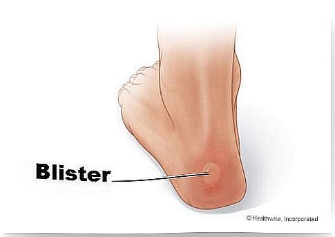 blisters