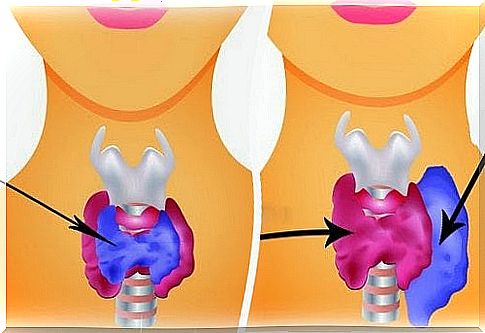 What is hyperthyroidism?