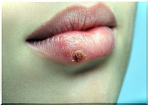 How To Prevent And Treat Cold Sores Naturally