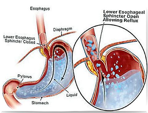 How to reduce acid reflux