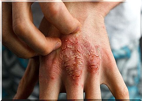 How to relieve the symptoms of psoriasis with sarsaparrilla