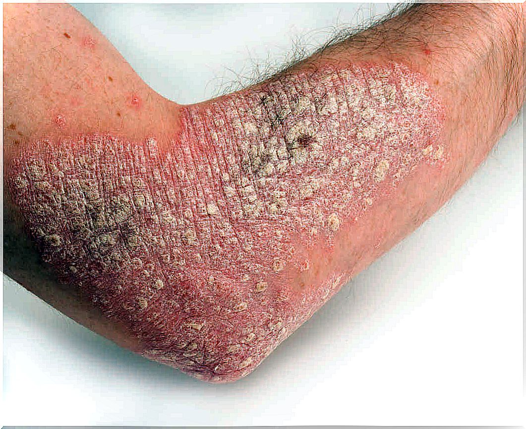 Person with psoriasis - relieve the symptoms of psoriasis