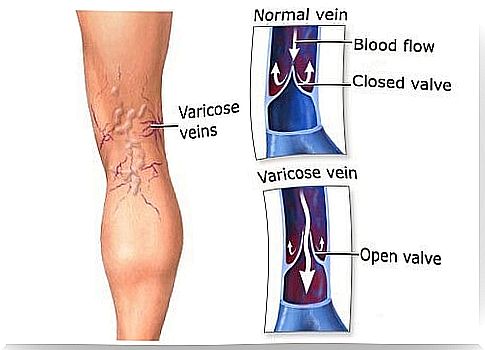 How to treat varicose veins with these 10 plants