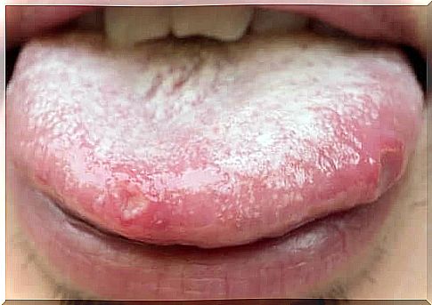 Oral candidiasis: Natural remedies