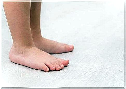 Flatfoot: Symptoms and treatment