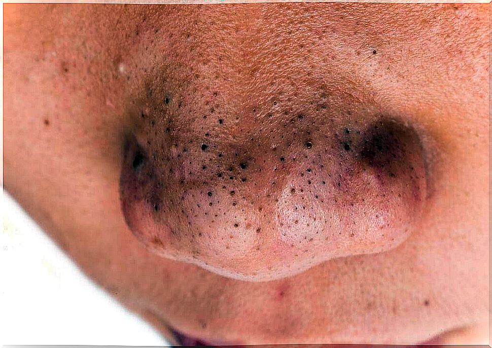 Blackheads