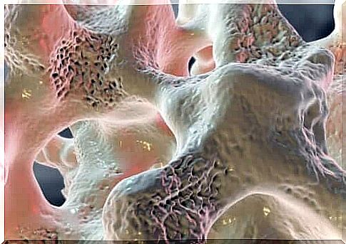 Illustration of osteoporosis due to low calcium