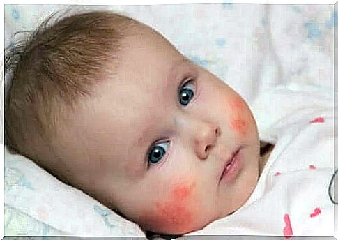 Atopic and seborrheic dermatitis in baby