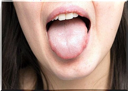 Woman with tongue out of mouth showing thick saliva