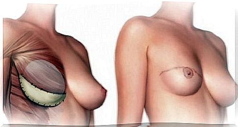 You should know this before a mastectomy