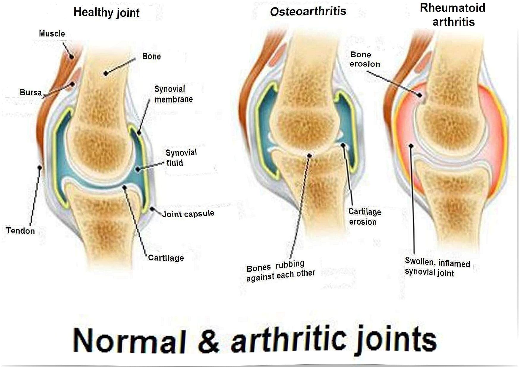 You should know the difference between arthritis, osteoarthritis and osteoporosis