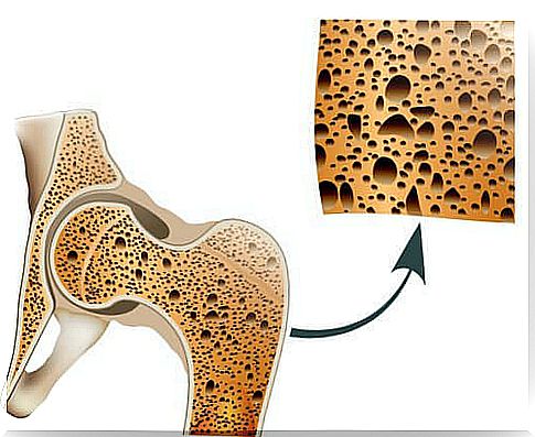 Osteoarthritis and osteoporosis are both tiring diseases.